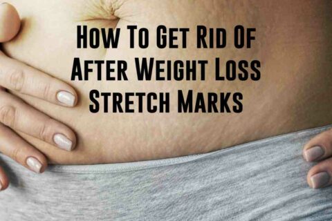 How To Get Rid Of After Weight Loss Stretch Marks