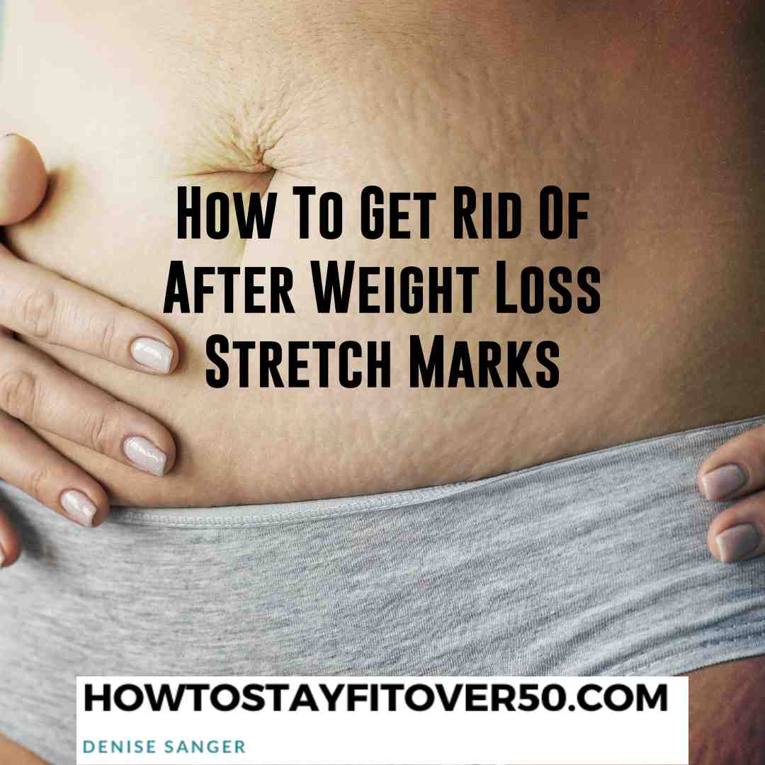 How To Get Rid Of After Weight Loss Stretch Marks